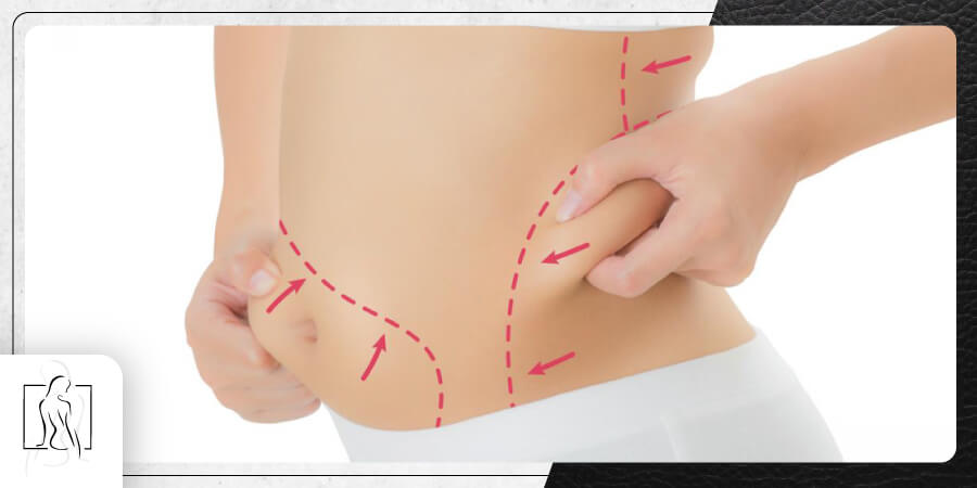 Cirujano-Plastico-Quito-Dr-Sebastian-Castillo-Nunez--Lipoescultura-PELV