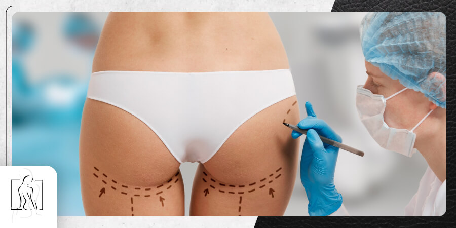 Cirujano-Plastico-Quito-Dr-Sebastian-Castillo-Nunez--aumento-de-gluteos-con-implantes