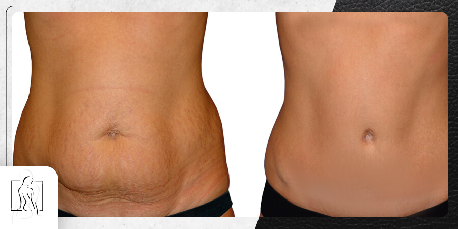 Cirujano-Plastico-Quito-Dr-Sebastian-Castillo-Nunez--correccion-de-cicatrices